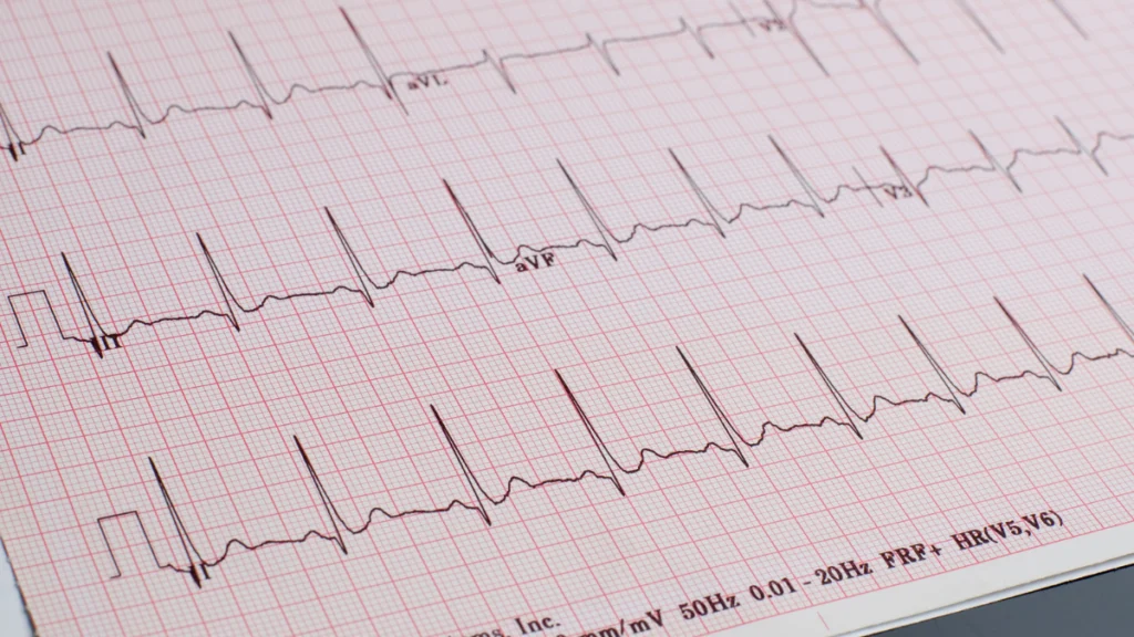 Lista ampla das possiveis alteracoes observadas no Eletrocardiograma ECG 1024x576 7